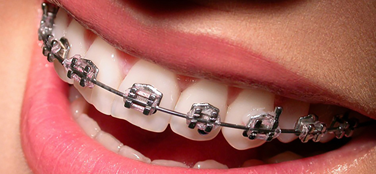 metalbraces