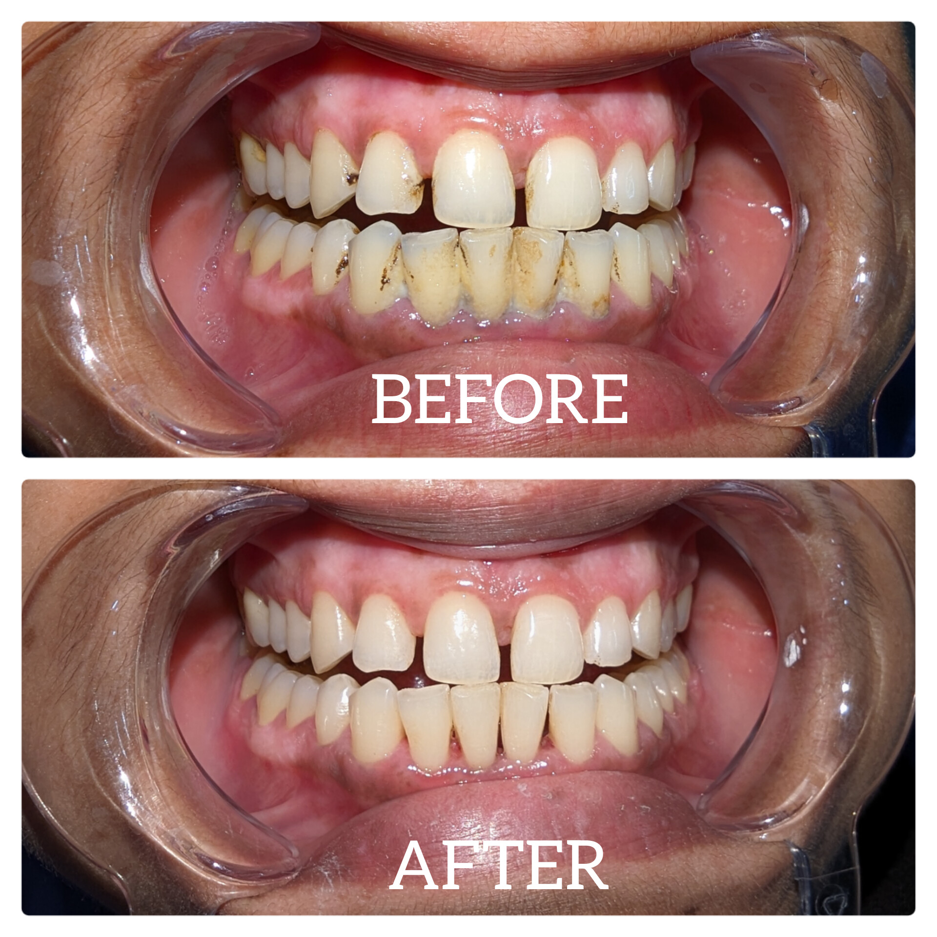 before-after-dental-treatment-case-1