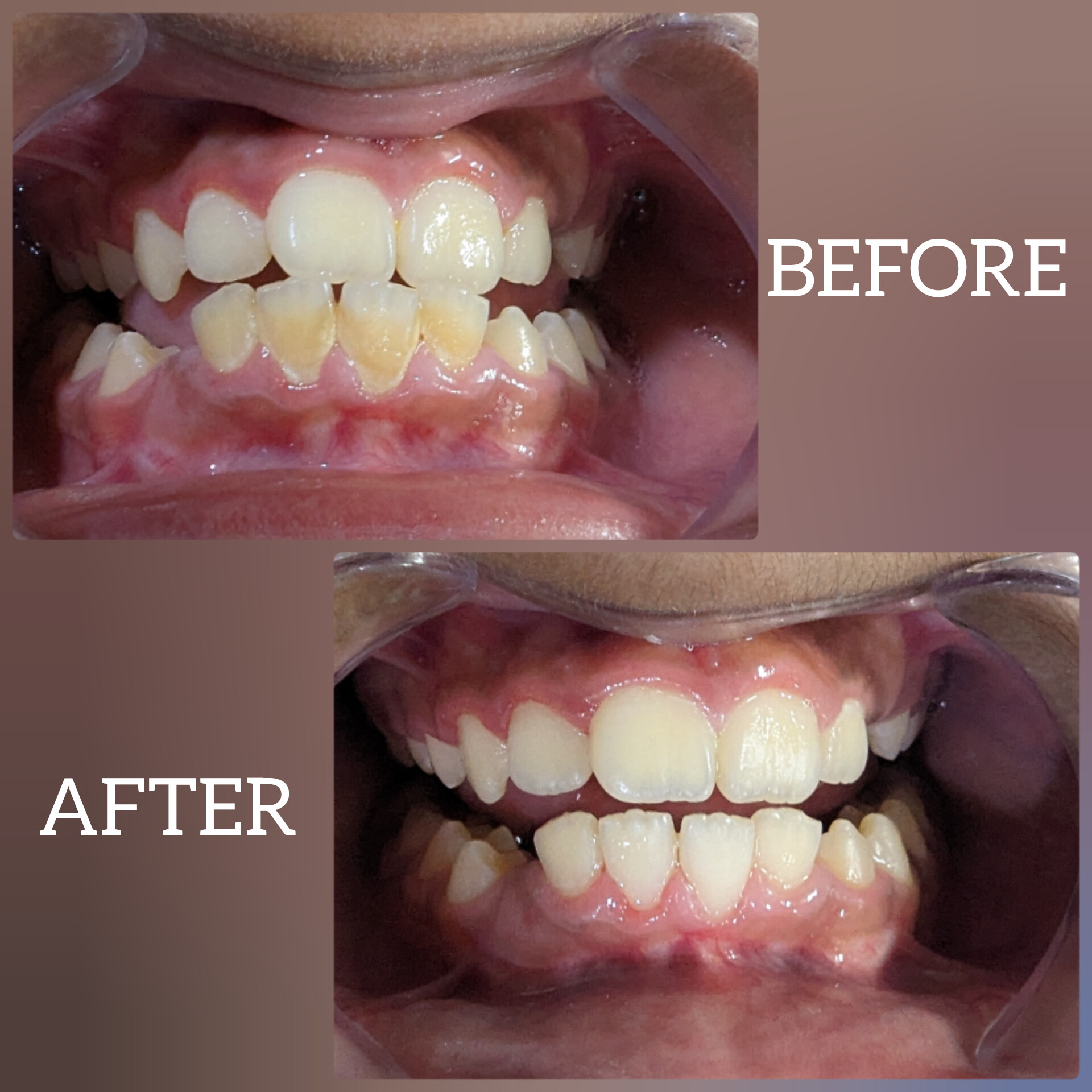 before-after-dental-treatment-case-2