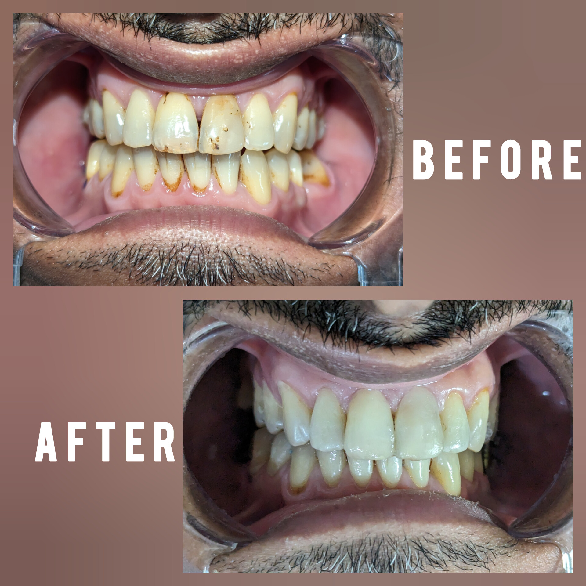 before-after-dental-treatment-case-3