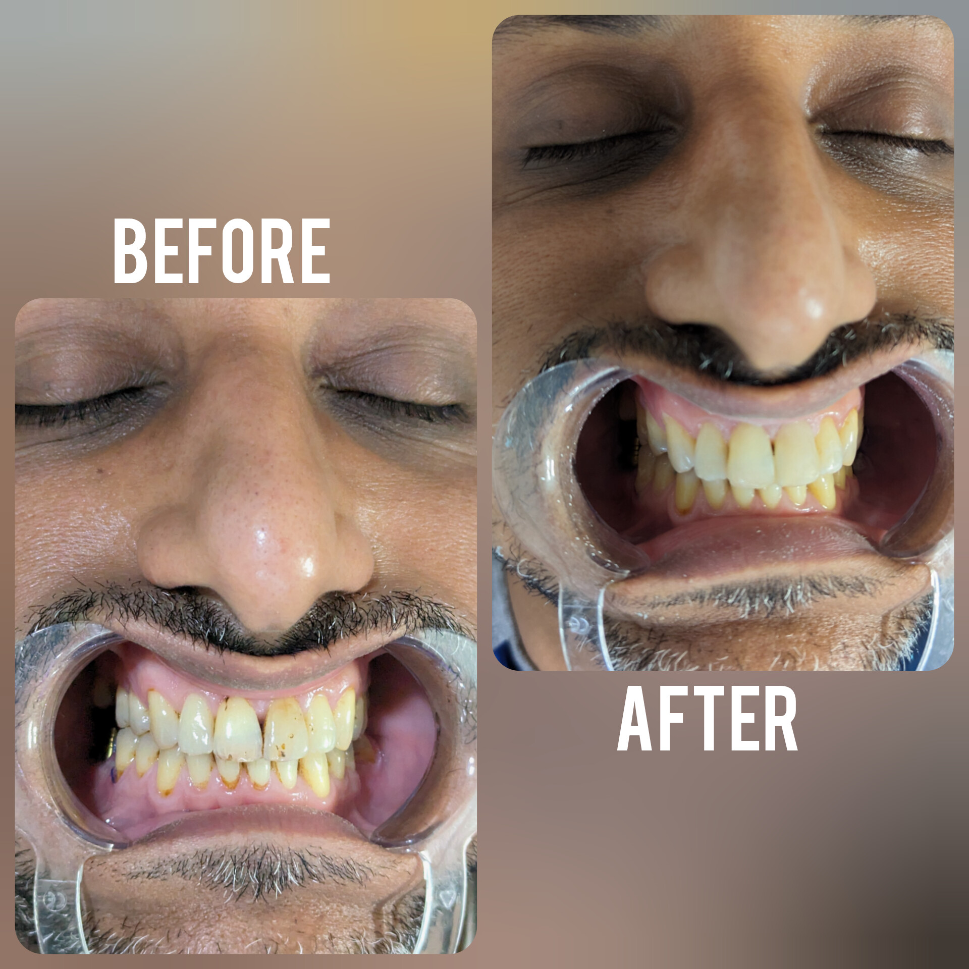 before-after-dental-treatment-case-4