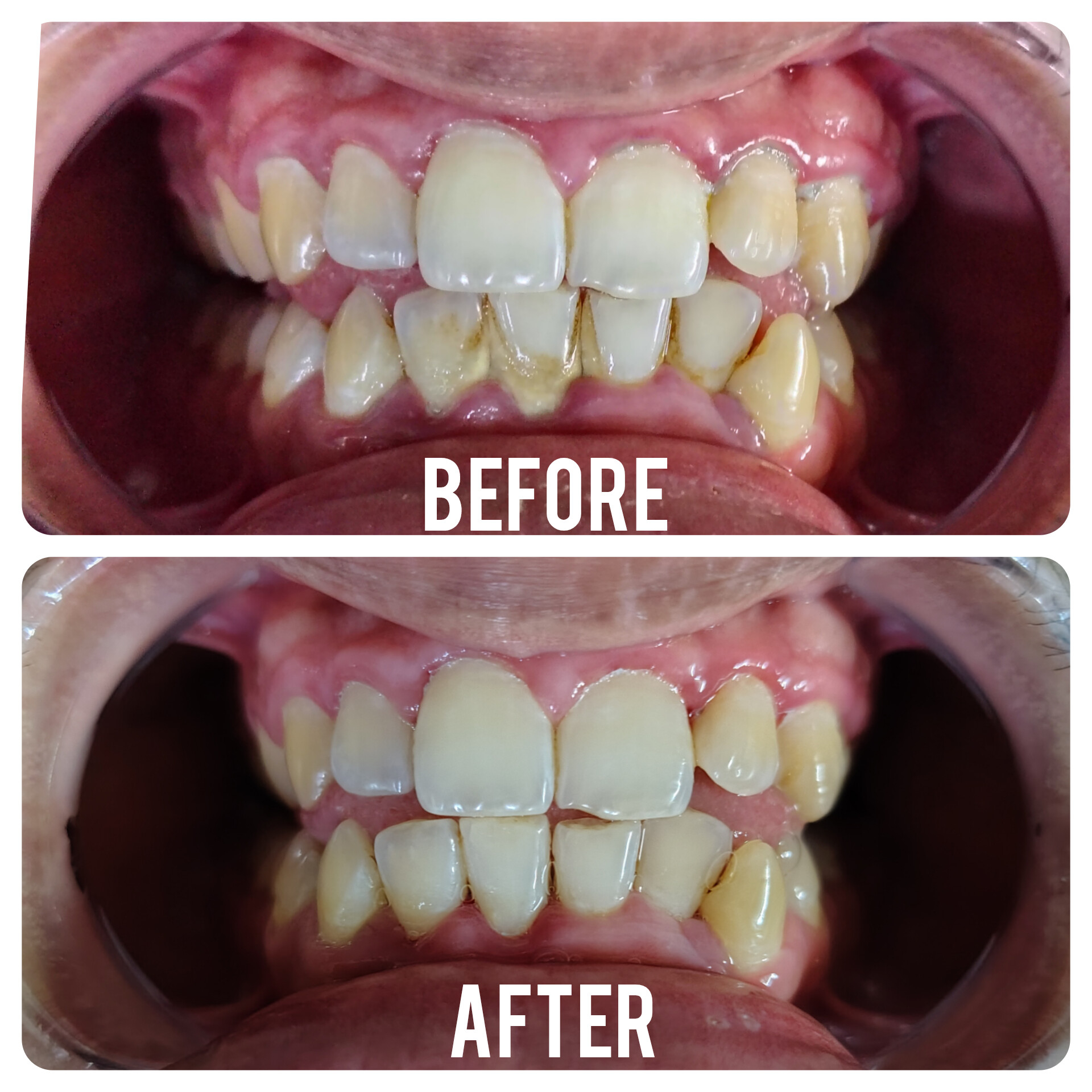 before-after-dental-treatment-case-5