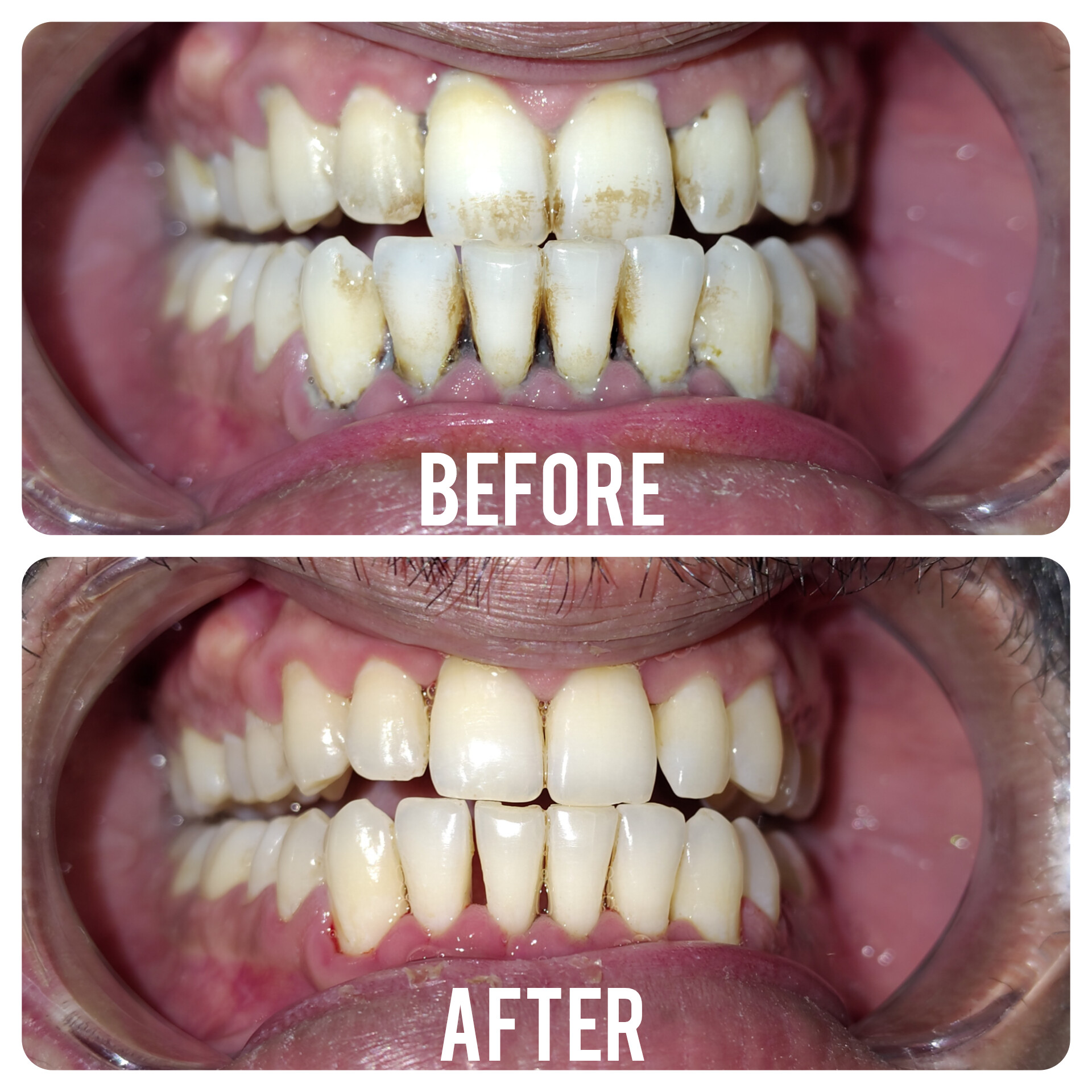 before-after-dental-treatment-case-6