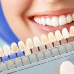 best teeth whitening services in Gurgaon