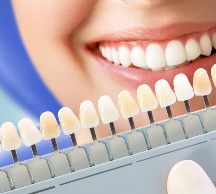 best teeth whitening services in Gurgaon