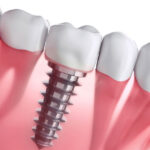 dental implants cost in Gurgaon