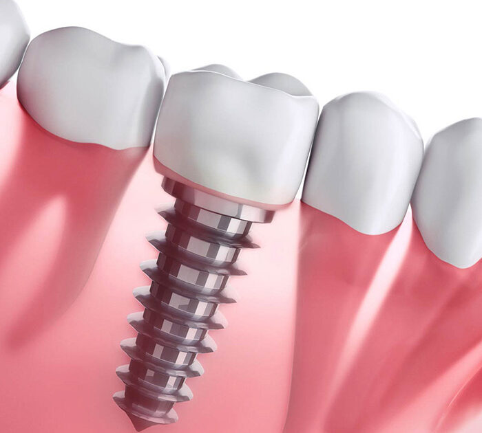 dental implants cost in Gurgaon