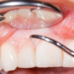 gum treatment in Gurgaon