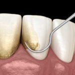 Teeth Cleaning Cost in Gurgaon