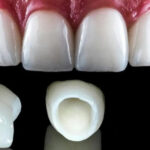 Zirconia Tooth Cap in Gurgaon