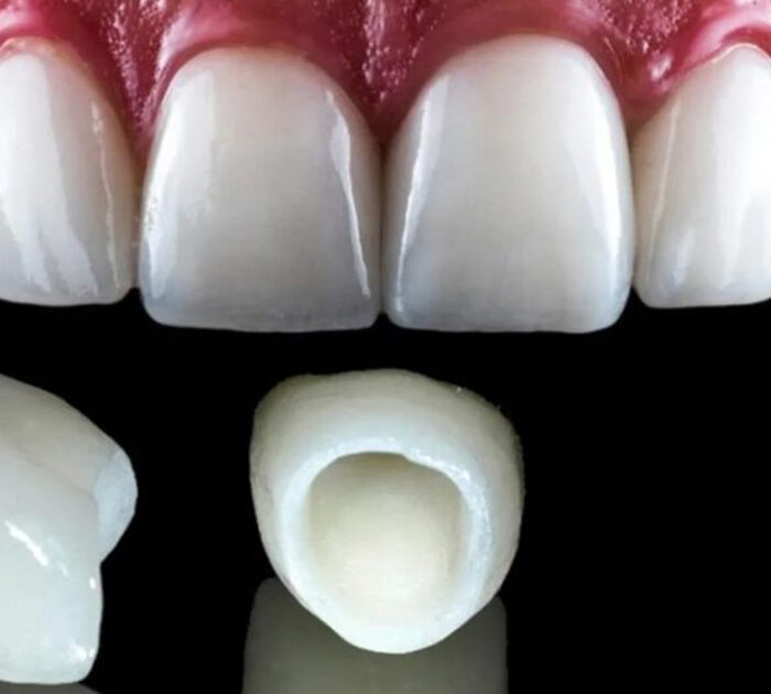 Zirconia Tooth Cap in Gurgaon