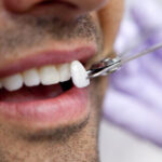 porcelain veneers in gurgaon