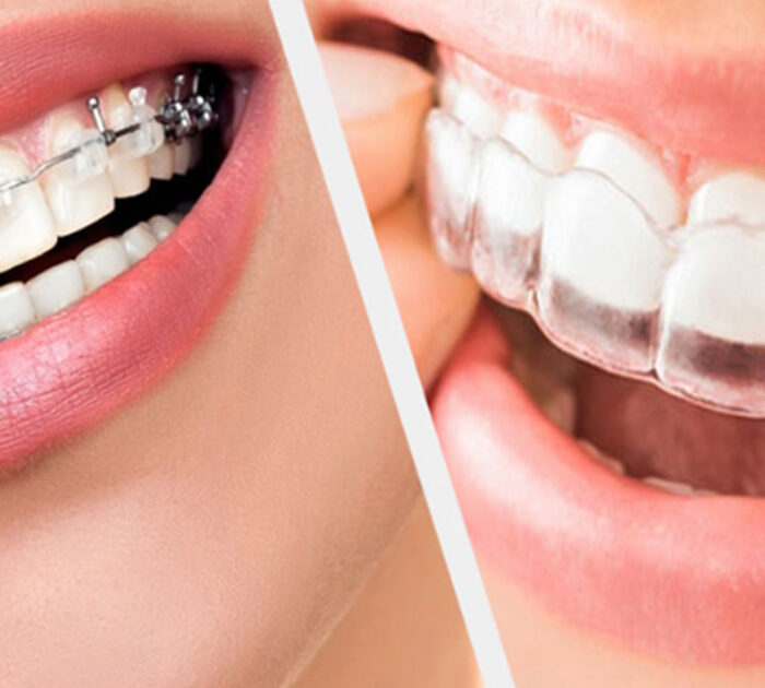 Clear Aligners vs. Braces