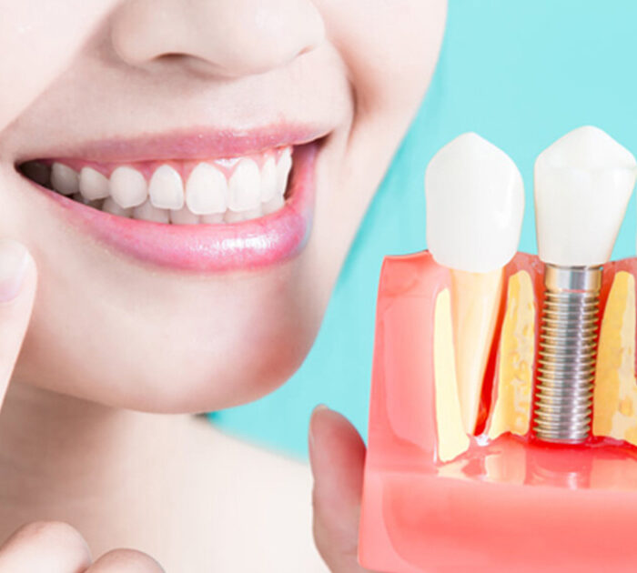 Missing Teeth - How Dental Implants Restore a Beautiful Smile