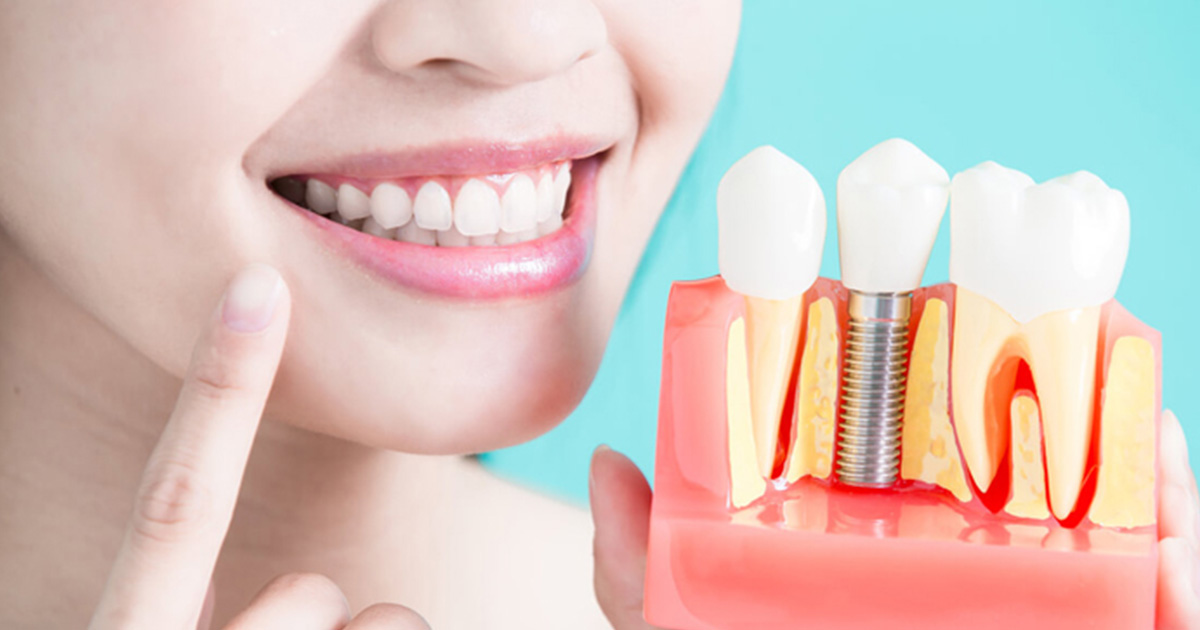 Missing Teeth - How Dental Implants Restore a Beautiful Smile