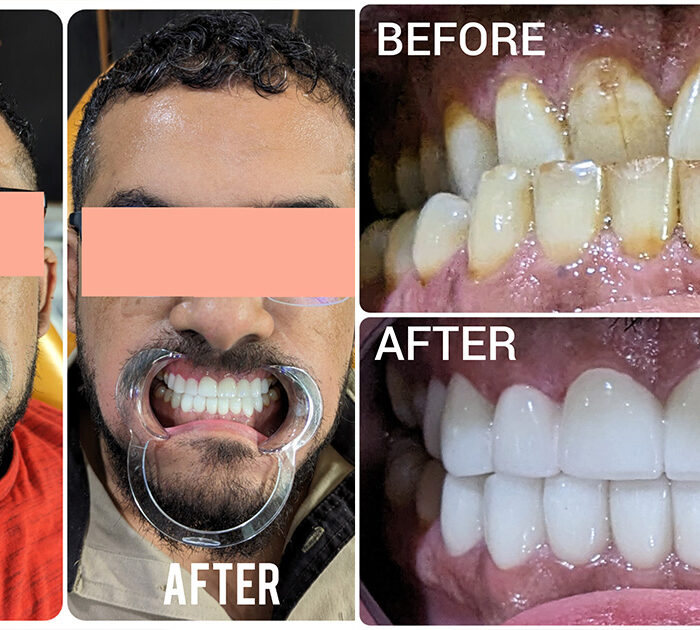 Teeth Whitening in Gurgaon - Achieve a Brighter, More Radiant Smile