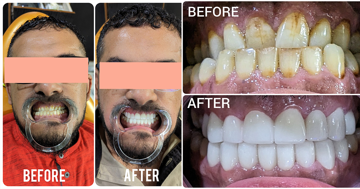 Teeth Whitening in Gurgaon - Achieve a Brighter, More Radiant Smile